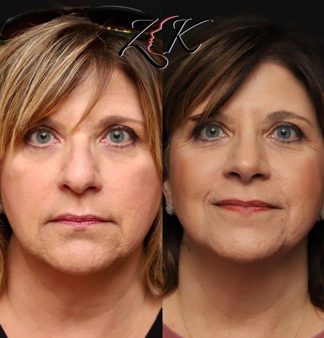 Primary rhinoplasty before and after photos of a female patient with thin skin, performed using rib cartilage grafting to enhance nasal structure and long-term support