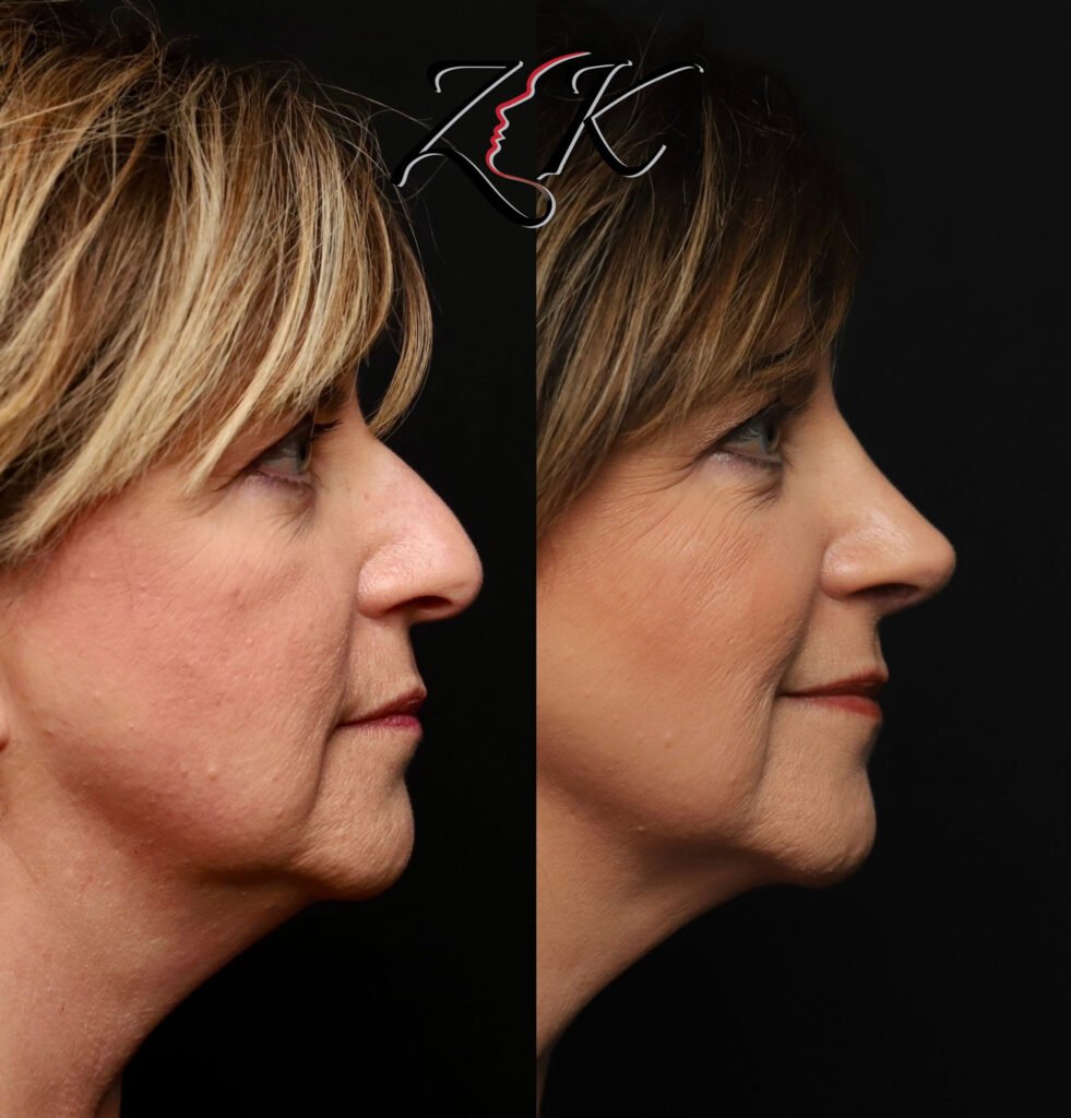 Primary rhinoplasty before and after right profile view of a female patient with thin skin, using rib cartilage grafting for structural nasal support