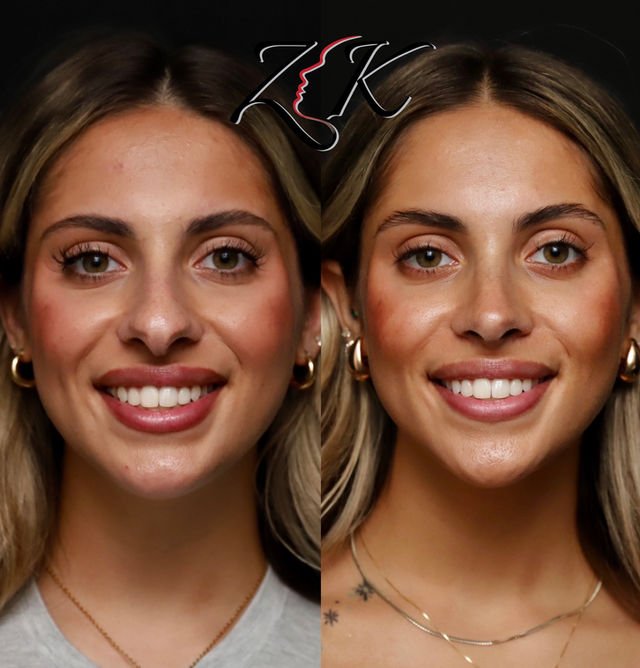 Primary Rhinoplasty Face View – Latino Female Patient (18–25) Using Rib Cartilage