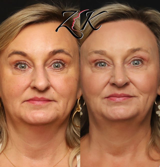 Primary rhinoplasty before and after view of a female patient in her 50s with thin skin, using septal cartilage to improve nasal structure and support