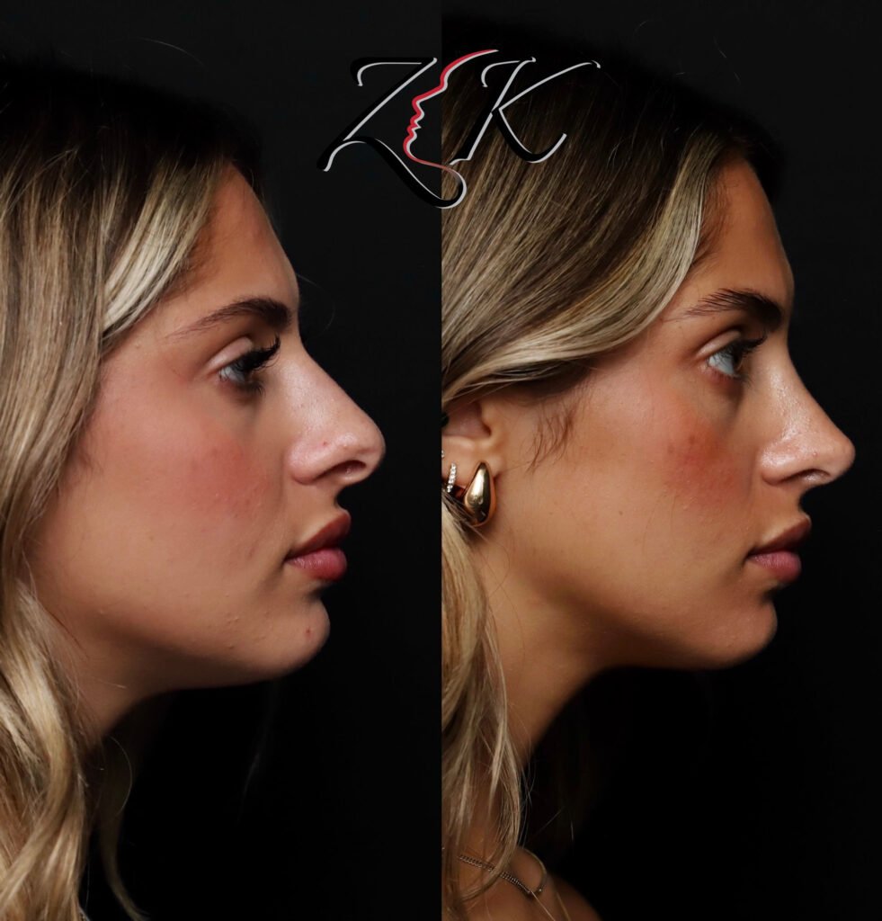 Primary rhinoplasty before and after right profile view of a Latino female patient aged 18–25 with thin skin, using rib cartilage grafting for structural nasal support
