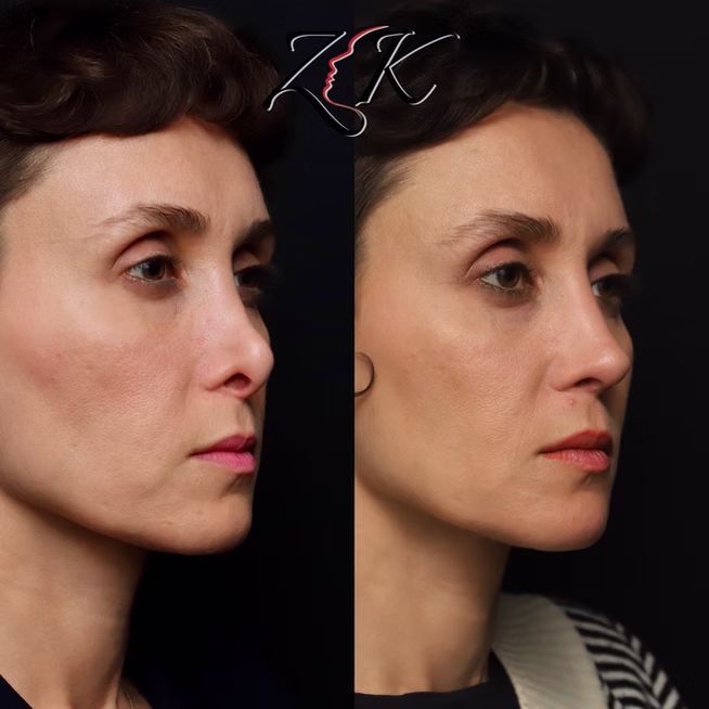 Rhinoplasty Before and After Results of a Women