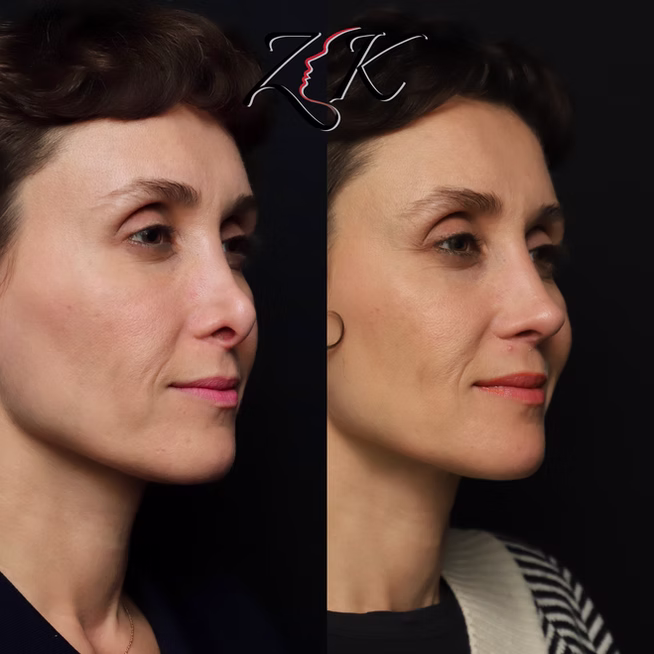 Rhinoplasty Before and After Results of a Women