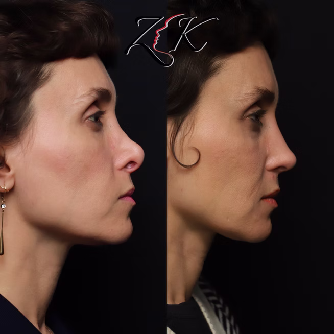Rhinoplasty Before and After Results of a Women-Right Profile