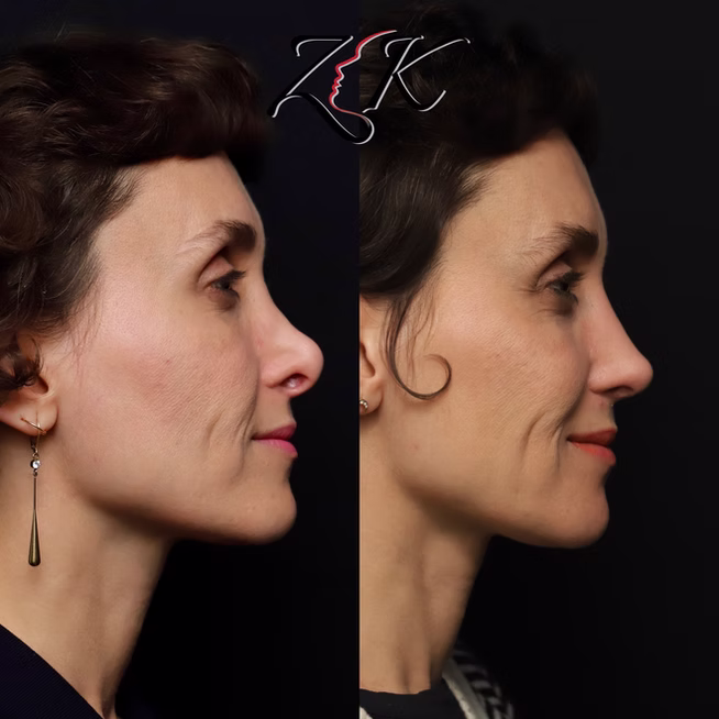 Rhinoplasty Before and After Results of a Women-Right Profile Smiling
