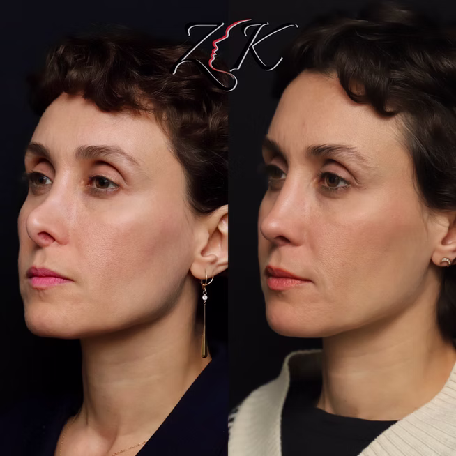 Rhinoplasty Before and After Results of a Women