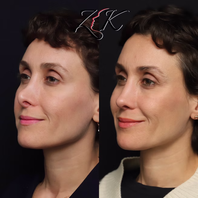 Rhinoplasty Before and After Results of a Women