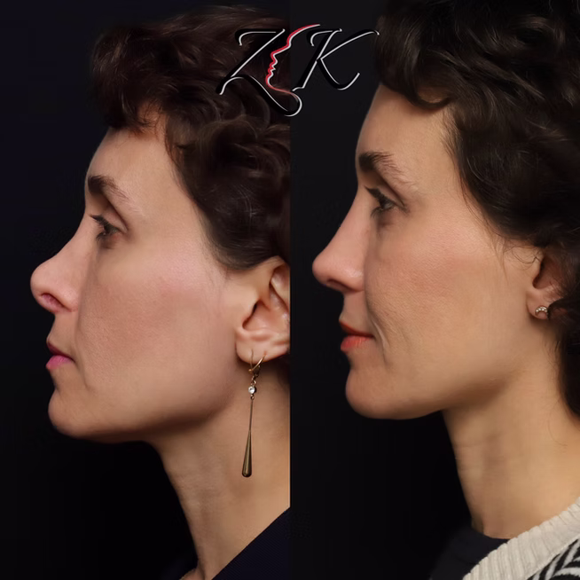 Rhinoplasty Before and After Results of a Women-Left Profile