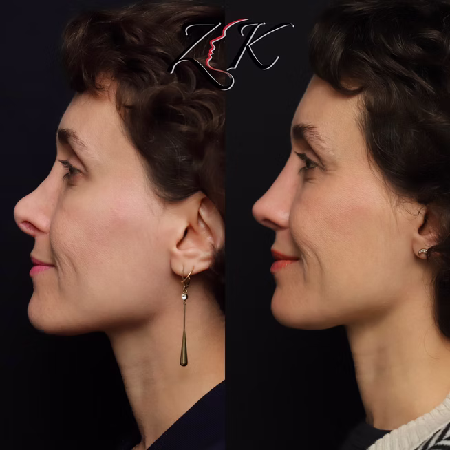 Rhinoplasty Before and After Results of a Women-Left Profile Smiling