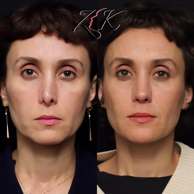 Rhinoplasty Before and After Results of a Women- Front Profile