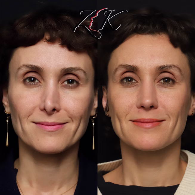 Rhinoplasty Before and After Results of a Women-Front Profile Smiling