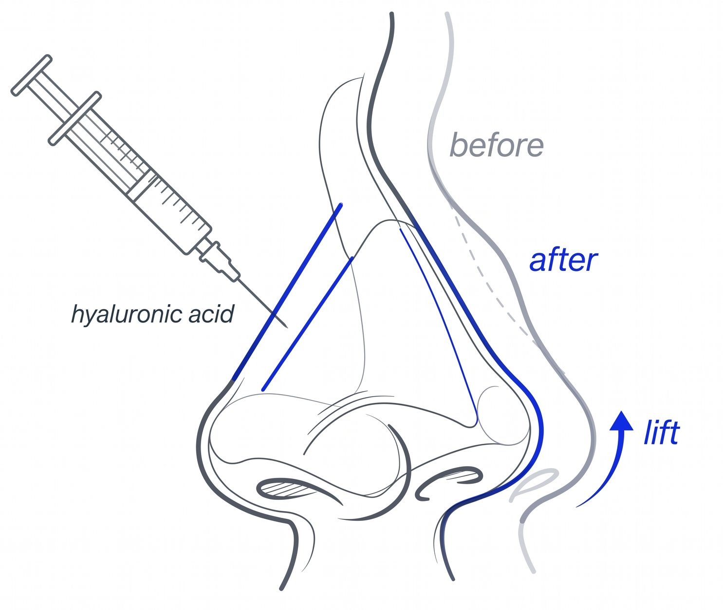 Liquid Rhinoplasty