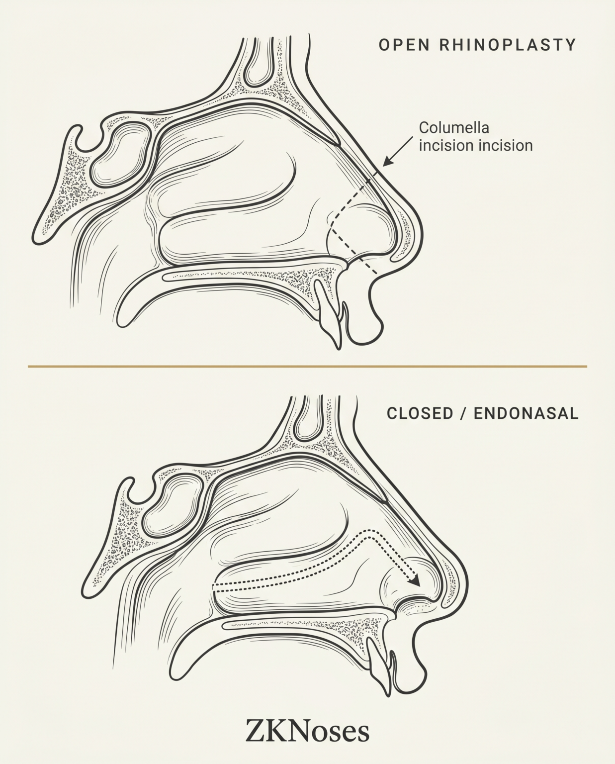 Open & Closed Rhinoplasty