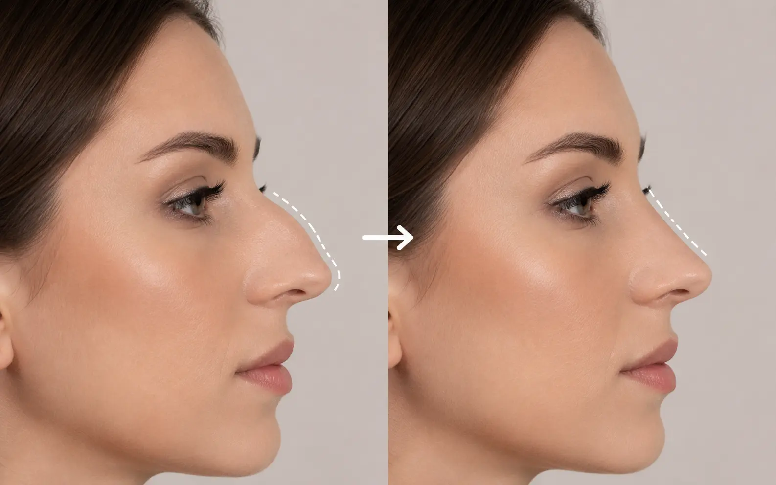 Dorsal Hump Removal Rhinoplasty