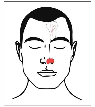 Nasal defect present. Artery is identified, and flap is designed on the forehead.